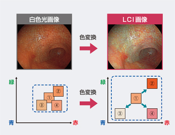 LCI（Linked Color Imaging）画像