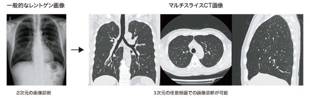 CT検査の原理